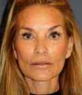 Feel Beautiful - Facelift 101 - After Photo